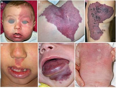 Vascular Birthmarks as a Clue for Complex and Syndromic Vascular Anomalies